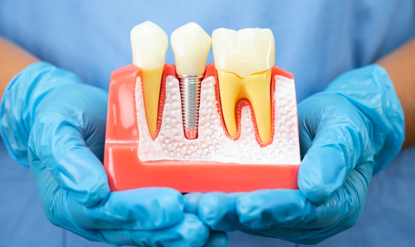 dental implants in League City